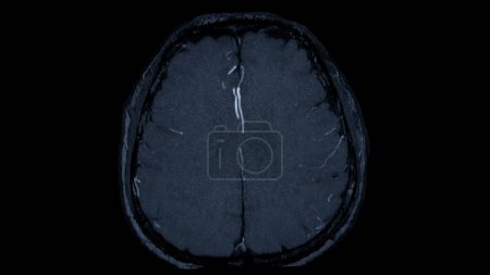MRA Vue axiale du cerveau, Cette technique d'imagerie fournit des images claires des structures artérielles et veineuses du cerveau, aidant au diagnostic des affections vasculaires et des problèmes neurologiques.