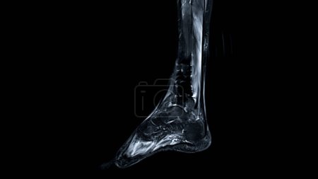 Photo for MRI FOOT scan Sagittal view T2 Fat suppression  technique   for diagnostic tendon injury. - Royalty Free Image