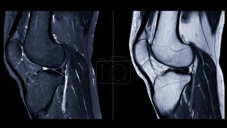 Imagerie par résonance magnétique ou IRM de l'articulation du genou. Cette technique diagnostique est cruciale pour évaluer les ligaments, le cartilage et identifier des problèmes tels que les larmes ou l'inflammation.