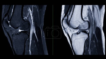 Magnetic resonance imaging or MRI of  knee joint. This diagnostic technique is crucial for assessing ligaments, cartilage, and identifying issues like tears or inflammation.
