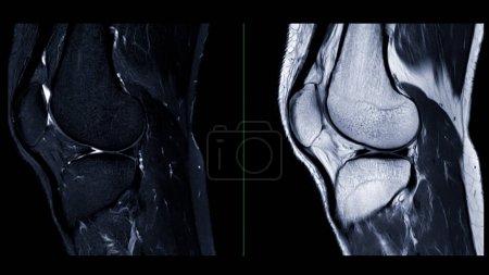 Resonancia magnética o resonancia magnética de la articulación de la rodilla. Esta técnica diagnóstica es crucial para evaluar ligamentos, cartílagos e identificar problemas como desgarros o inflamación..