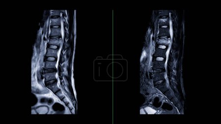 Photo for MRI L-S spine or lumbar spine Sagittal  view  for diagnosis spinal cord compression. - Royalty Free Image