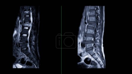 MRI L-S spine or lumbar spine Sagittal  view  for diagnosis spinal cord compression.