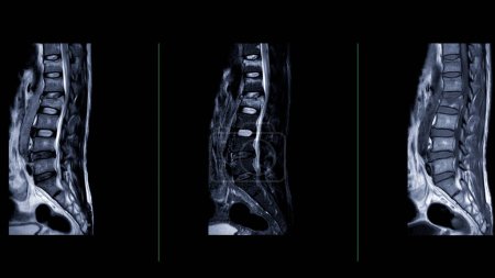Photo for MRI L-S spine or lumbar spine Sagittal  view  for diagnosis spinal cord compression. - Royalty Free Image