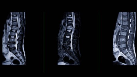 Foto de Resonancia magnética L-S columna vertebral o columna lumbar Vista sagital para el diagnóstico compresión de la médula espinal. - Imagen libre de derechos