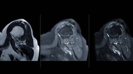 MRI of the shoulder joint sagittal view is a non-invasive imaging technique providing detailed insights into the structures of the shoulder. for evaluating tendons, muscles.