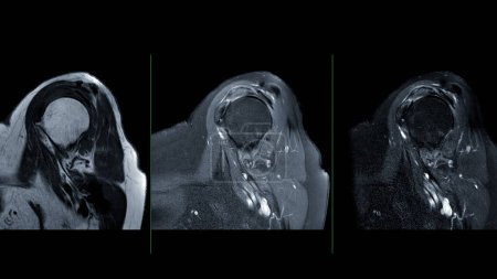 MRI of the shoulder joint sagittal view is a non-invasive imaging technique providing detailed insights into the structures of the shoulder. for evaluating tendons, muscles.
