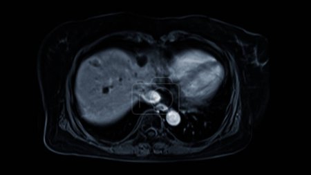 La RMN de la vista axial del abdomen superior es una técnica de imagen no invasiva que proporciona imágenes detalladas de órganos como el hígado, el páncreas y los riñones..