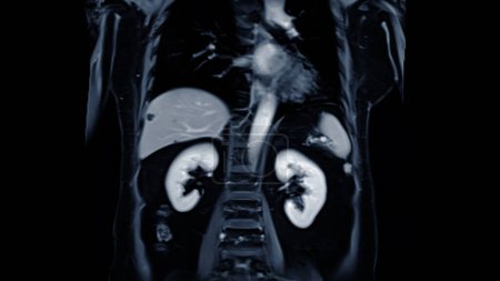 MRI of the upper abdomen coronal view is a non-invasive imaging technique providing detailed visuals of organs like the liver, pancreas, and kidneys.