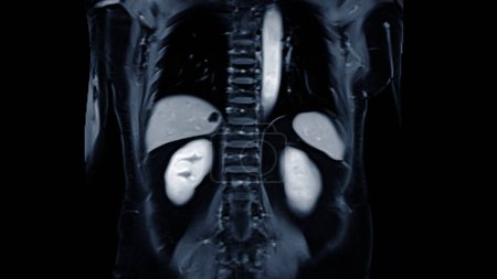 MRI of the upper abdomen coronal view is a non-invasive imaging technique providing detailed visuals of organs like the liver, pancreas, and kidneys.
