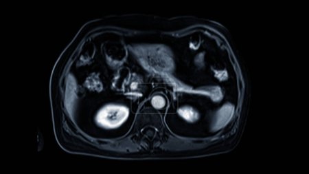 MRT der Oberbauchachse ist eine nicht-invasive bildgebende Technik, die detaillierte Visualisierungen von Organen wie Leber, Bauchspeicheldrüse und Nieren ermöglicht.