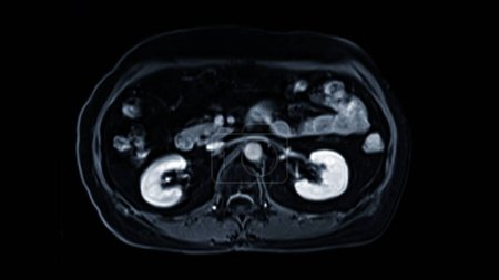 MRI of the upper abdomen axial view is a non-invasive imaging technique providing detailed visuals of organs like the liver, pancreas, and kidneys.