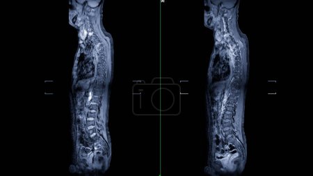 Photo for An MRI of the whole spine image is a comprehensive visual representation produced through Magnetic Resonance Imaging, providing detailed insights into the entire spinal structure. - Royalty Free Image