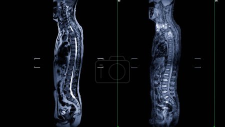Una resonancia magnética de toda la imagen de la columna vertebral es una representación visual integral producida a través de imágenes por resonancia magnética, proporcionando información detallada sobre toda la estructura espinal..