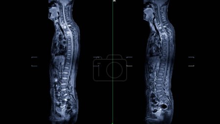 An MRI of the whole spine image is a comprehensive visual representation produced through Magnetic Resonance Imaging, providing detailed insights into the entire spinal structure.