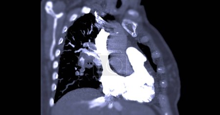 Téléchargez les photos : Une artère pulmonaire CTA révèle une vue détaillée des vaisseaux sanguins pulmonaires, capturant la présence d'une embolie pulmonaire, une condition où un caillot sanguin perturbe le flux sanguin normal. - en image libre de droit