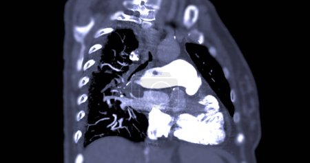 Eine CTA-Lungenarterie zeigt eine detaillierte Ansicht der Lungengefäße und erfasst das Vorhandensein einer Lungenembolie, ein Zustand, bei dem ein Blutgerinnsel den normalen Blutfluss stört..