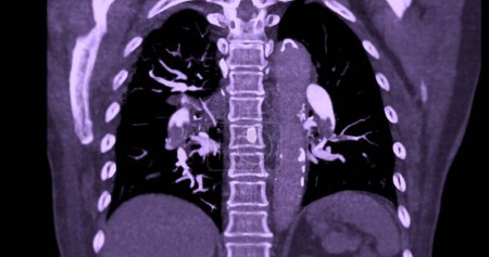 Téléchargez les photos : Une artère pulmonaire CTA révèle une vue détaillée des vaisseaux sanguins pulmonaires, capturant la présence d'une embolie pulmonaire, une condition où un caillot sanguin perturbe le flux sanguin normal. - en image libre de droit