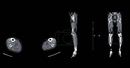 Téléchargez les photos : Un venogramme CT de la jambe est une procédure d'imagerie non invasive offrant des images détaillées des veines de la jambe. - en image libre de droit