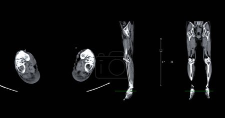 Photo for A CT venogram of the leg is a non-invasive imaging procedure offering detailed visuals of leg veins. - Royalty Free Image