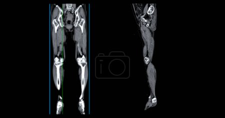 Foto de Un venograma por TC de la pierna es un procedimiento de imagen no invasivo que ofrece imágenes detalladas de las venas de las piernas.. - Imagen libre de derechos