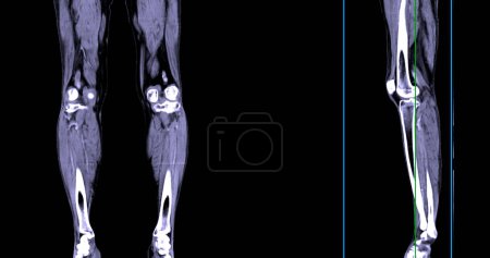 Un venogramme CT de la jambe est une procédure d'imagerie non invasive offrant des images détaillées des veines de la jambe.