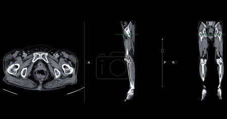 A CT venogram of the leg is a non-invasive imaging procedure offering detailed visuals of leg veins.