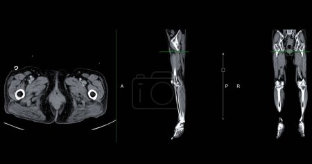 Téléchargez les photos : Un venogramme CT de la jambe est une procédure d'imagerie non invasive offrant des images détaillées des veines de la jambe. - en image libre de droit