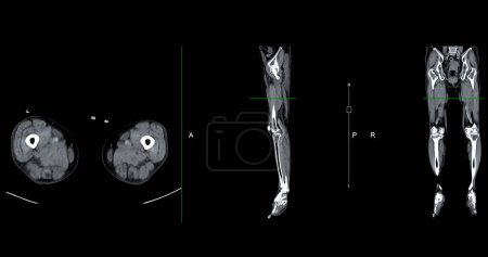 Un venogramme CT de la jambe est une procédure d'imagerie non invasive offrant des images détaillées des veines de la jambe.