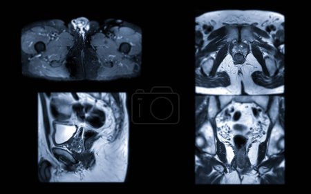La RM de la glándula prostática revela lesión SI anormal focal en PZpl izquierdo en el ápice como se describe; PI-RADS categoría 4, clinicall
