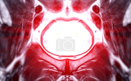MRT der Prostata zeigt fokale abnorme SI-Läsion am linken PZpl am Scheitelpunkt wie beschrieben; PI-RADS Kategorie 4, klinisch