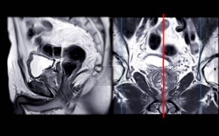 MRI of the prostate gland reveals Focal abnormal SI lesion at left PZpl at apex as described; PI-RADS category 4, clinicall