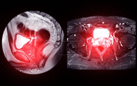 MRT der Prostata zeigt fokale abnorme SI-Läsion am linken PZpl am Scheitelpunkt wie beschrieben; PI-RADS Kategorie 4, klinisch