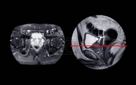 Photo for MRI of the prostate gland reveals Focal abnormal SI lesion at left PZpl at apex as described; PI-RADS category 4, clinicall - Royalty Free Image