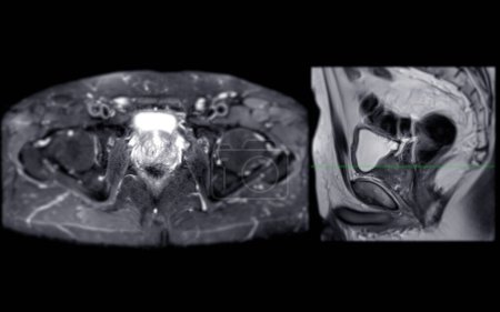 Photo for MRI of the prostate gland reveals Focal abnormal SI lesion at left PZpl at apex as described; PI-RADS category 4, clinicall - Royalty Free Image