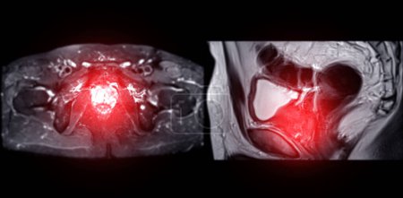 La RM de la glándula prostática revela lesión SI anormal focal en PZpl izquierdo en el ápice como se describe; PI-RADS categoría 4, clinicall