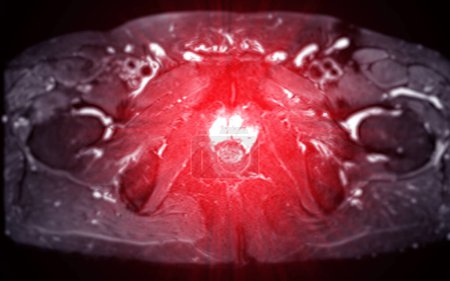 IRM de la prostate révèle une lésion SI focale anormale à gauche PZpl à l'apex comme décrit ; PI-RADS catégorie 4, clinicall
