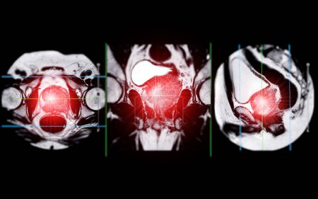 L'IRM de la prostate révèle une lésion focale anormale de l'intensité du signal (IS) dans les zones périphériques postérolatérales gauches à l'apex, ce qui aide à diagnostiquer les tumeurs et à orienter les décisions thérapeutiques..