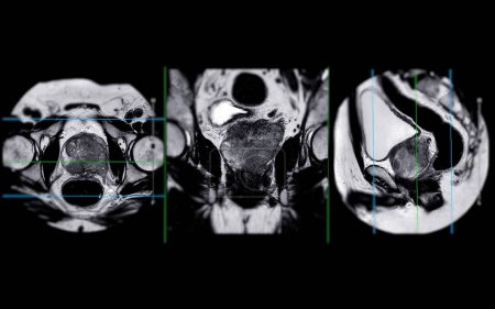 Photo for MRI of the prostate gland reveals a focal abnormal signal intensity (SI) lesion at the left posterolateral peripheral zones at the apex, aiding in diagnosing tumors and guiding treatment decisions. - Royalty Free Image
