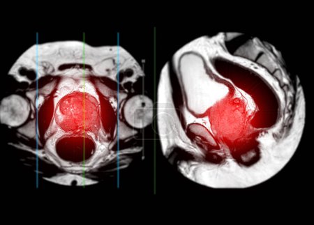 Photo for MRI of the prostate gland reveals a focal abnormal signal intensity (SI) lesion at the left posterolateral peripheral zones at the apex, aiding in diagnosing tumors and guiding treatment decisions. - Royalty Free Image