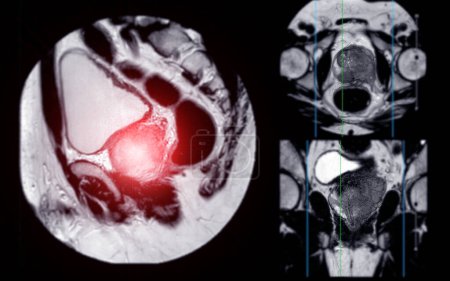MRT der Prostata zeigt eine fokale abnorme Signalintensität (SI) an den linken posterolateralen peripheren Zonen am Scheitelpunkt, die bei der Diagnose von Tumoren hilft und Behandlungsentscheidungen lenkt.