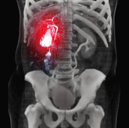 Magnetresonanz-Cholangiopankreatographie oder MRCP mit Gallenblase, Gallen- und Bauchspeicheldrüsengängen am Knochen 3D.
