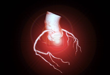 El renderizado 3D de la arteria coronaria CTA es una técnica de diagnóstico por imágenes que captura imágenes detalladas de los vasos sanguíneos del corazón en el diagnóstico de enfermedades de las arterias coronarias y la evaluación de la salud cardíaca..