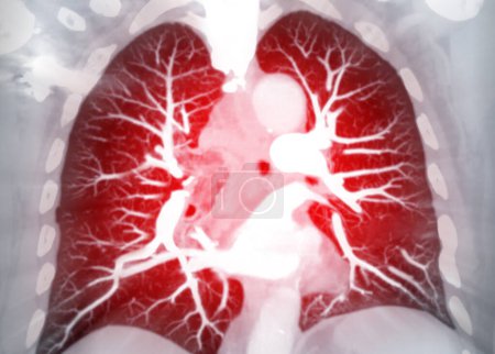 CTPA oder CTA Lungenarterie. Diese bildgebende Technik bietet eine klare Sicht auf die Lungenarterien und hilft bei der Diagnose von Lungenembolie, Gefäßerkrankungen und anderen Atemwegsproblemen.