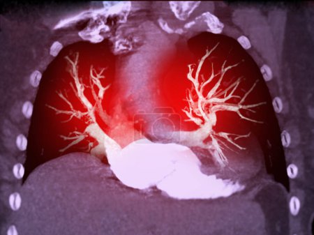 Téléchargez les photos : CTA Chest ou CTPA avec contraste rendu 3D pour diagnostic Embolie pulmonaire (PE) . - en image libre de droit