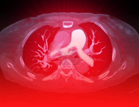 A CTA pulmonary artery reveals a detailed view of the lung blood vessels, capturing the presence of a pulmonary embolism, a condition where a blood clot disrupts normal blood flow.