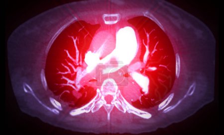 Une artère pulmonaire CTA révèle une vue détaillée des vaisseaux sanguins pulmonaires, capturant la présence d'une embolie pulmonaire, une condition où un caillot sanguin perturbe le flux sanguin normal.