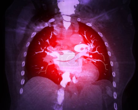 Eine CTA-Lungenarterie zeigt eine detaillierte Ansicht der Lungengefäße und erfasst das Vorhandensein einer Lungenembolie, ein Zustand, bei dem ein Blutgerinnsel den normalen Blutfluss stört..