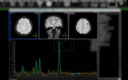 La spectroscopie par résonance magnétique facilite les maladies cardiovasculaires, fournissant une analyse chimique perspicace pour comprendre les changements métaboliques dans les tissus cérébraux affectés.