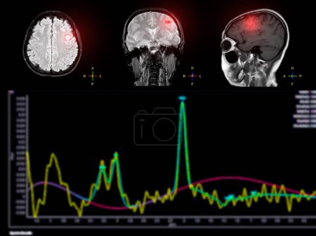 Photo for MR spectroscopy aids in stroke diseases, providing insightful chemical analysis to understand metabolic changes in affected brain tissues. - Royalty Free Image